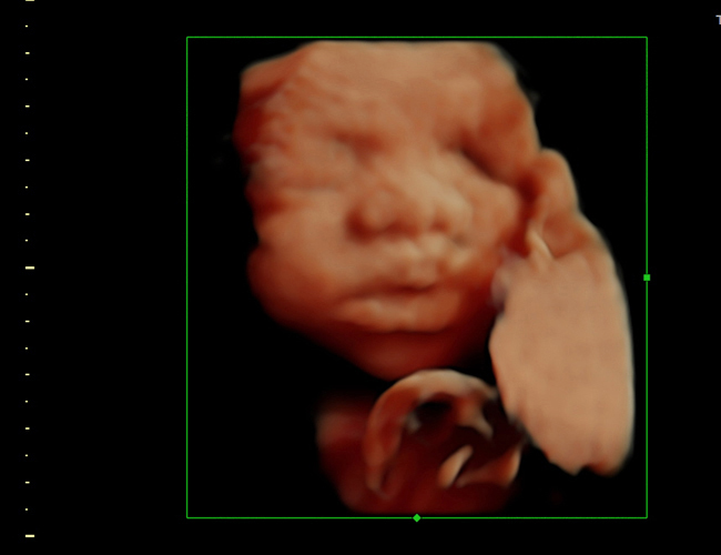 3D ultrasound image at 30 weeks